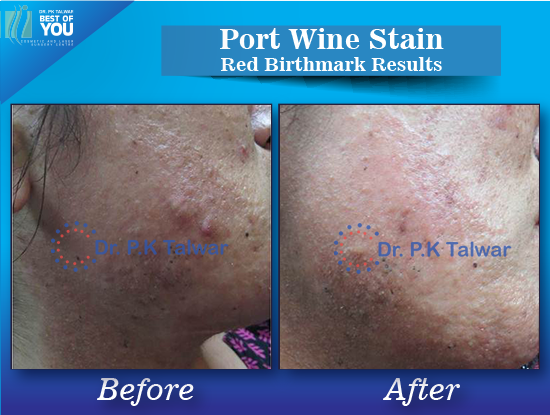 Pulsed Dye Laser Treatment